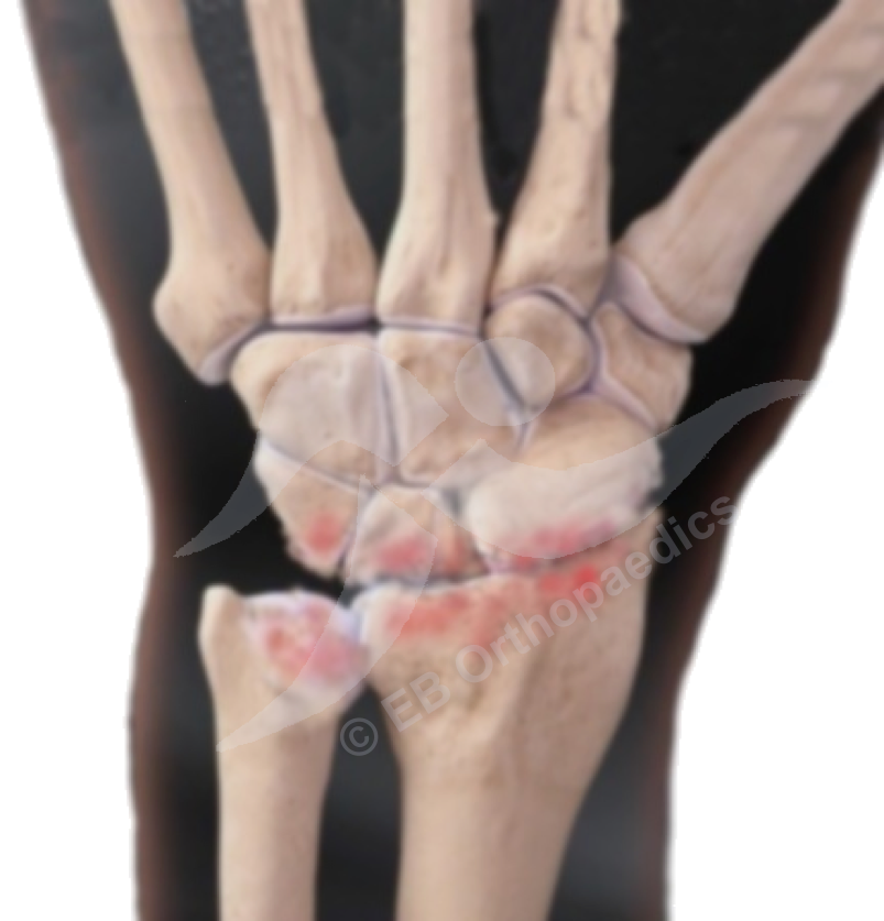 Wrist arthritis